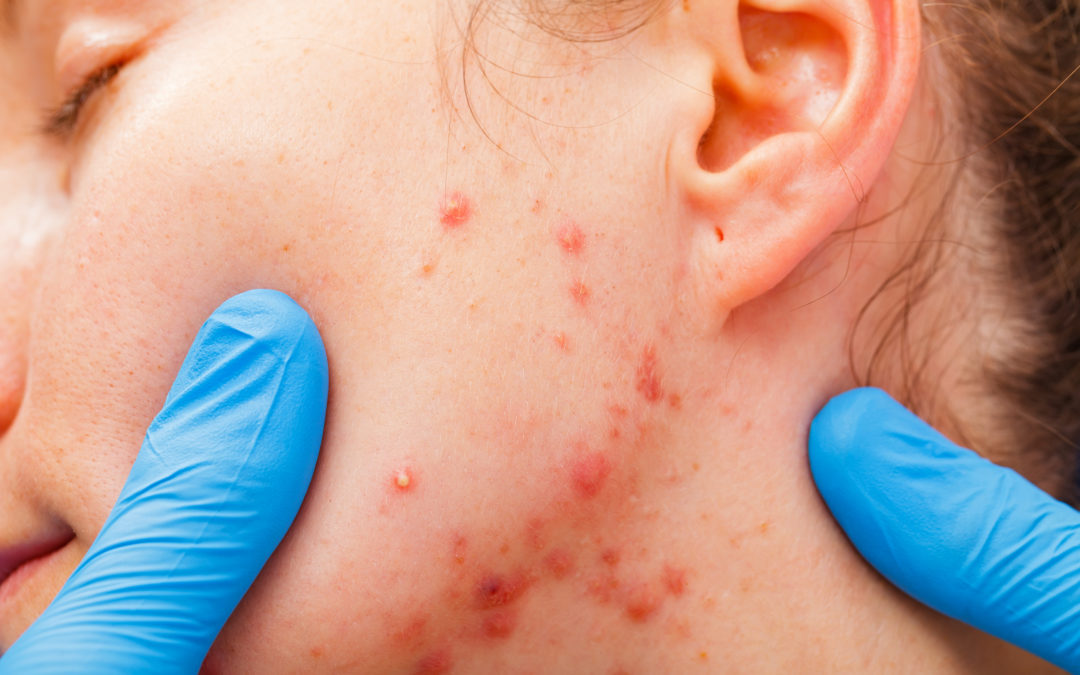 Acne and Extractions Course