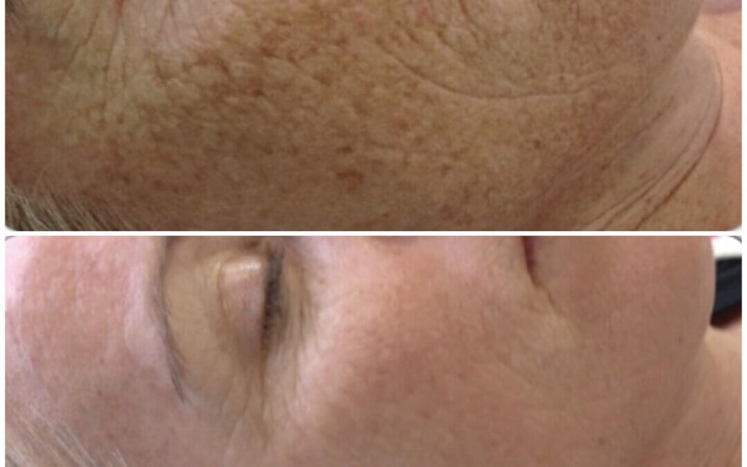 Microneedling Packages Available! So Many Choices!