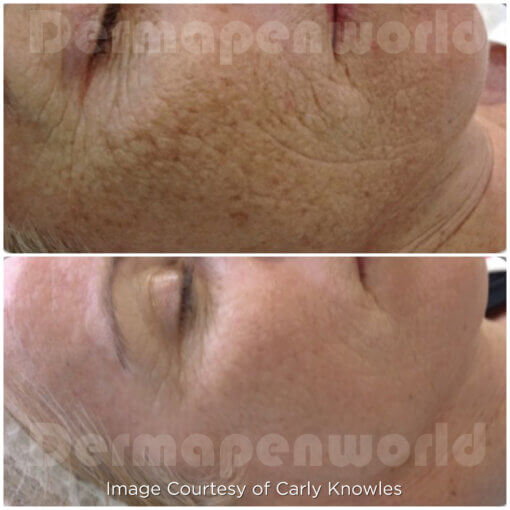 Exosome Microneedling Treatment - Image 7