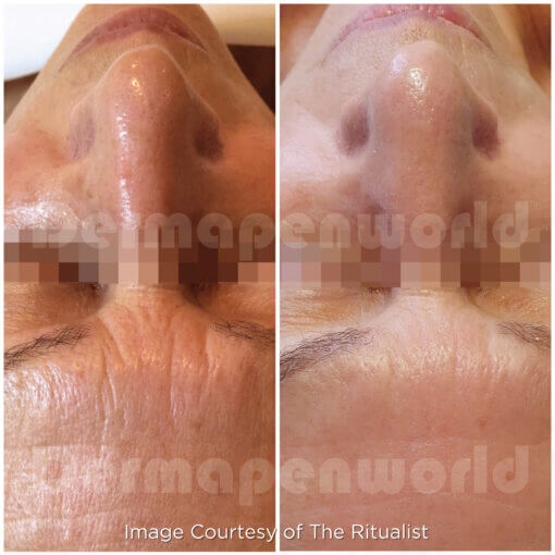 Exosome Microneedling Treatment - Image 5