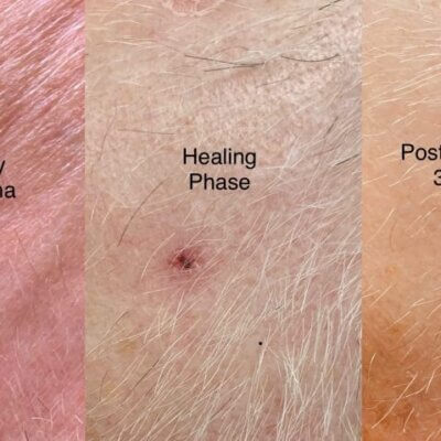 Three-panel sequence showing a cherry angioma before treatment, during healing, and 30 days after treatment.