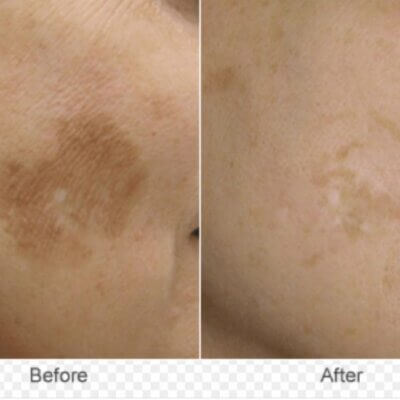 Before and after photos of a brown patch on the cheek showing treatment improvement. Left panel: large dark spot; right panel: faded patch and lighter skin tone.