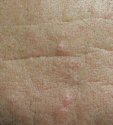 Skin Classic for Sebaceous Hyperplasia