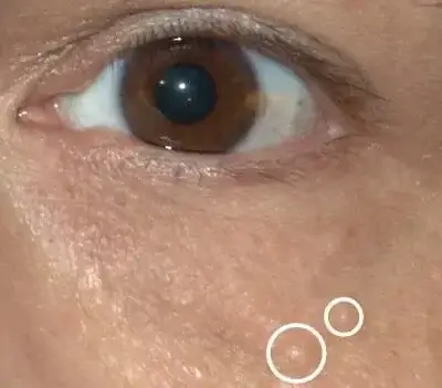 Close-up of a brown eye and cheek with two white outline circles highlighting small skin blemishes on the cheek area.