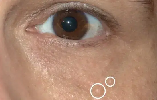 Close-up of a brown eye and cheek with two white outline circles highlighting small skin blemishes on the cheek area.